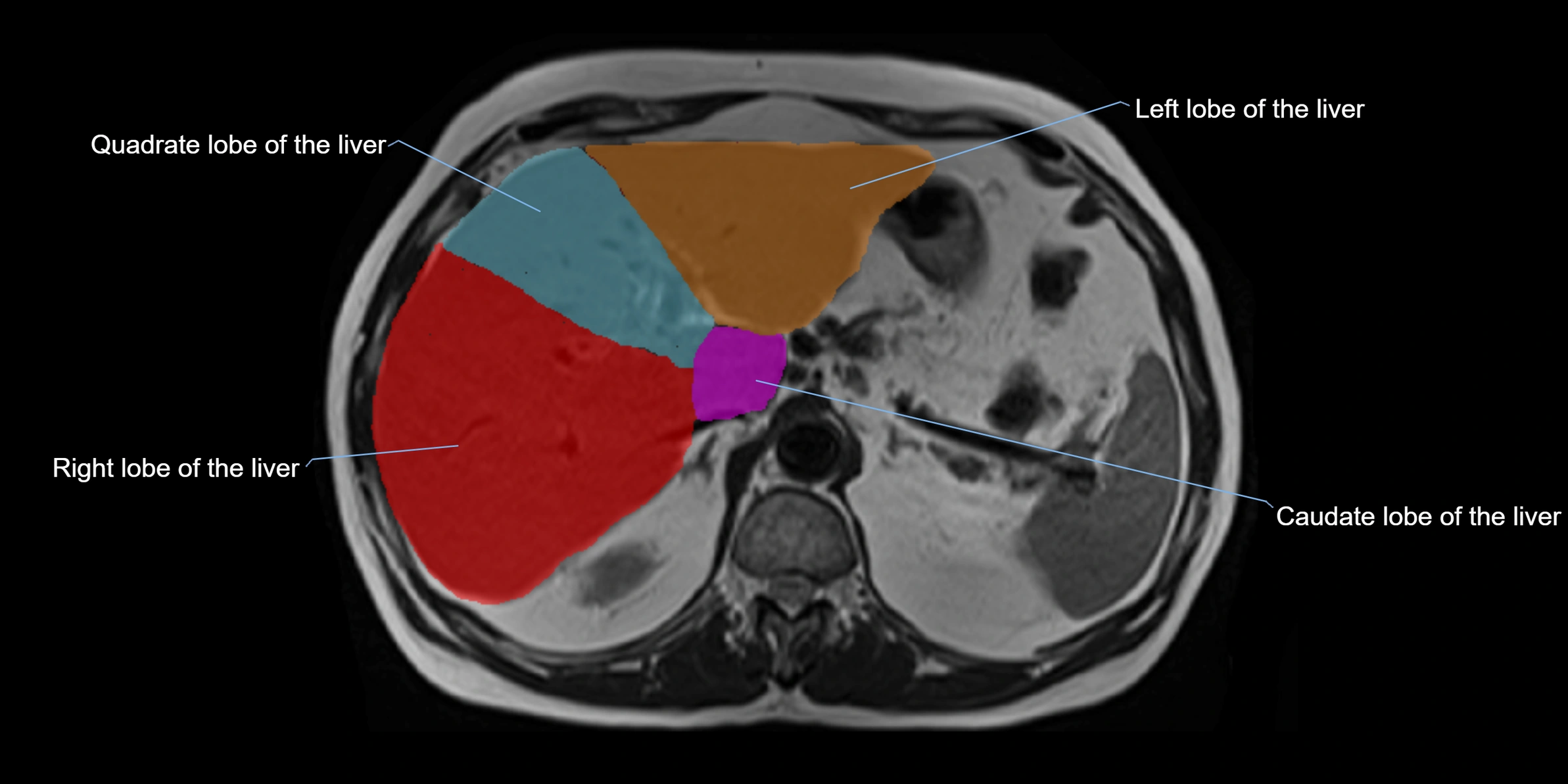 MRI liver lobe axial cross sectional 3T radiology  image-img-00001-00013.webp